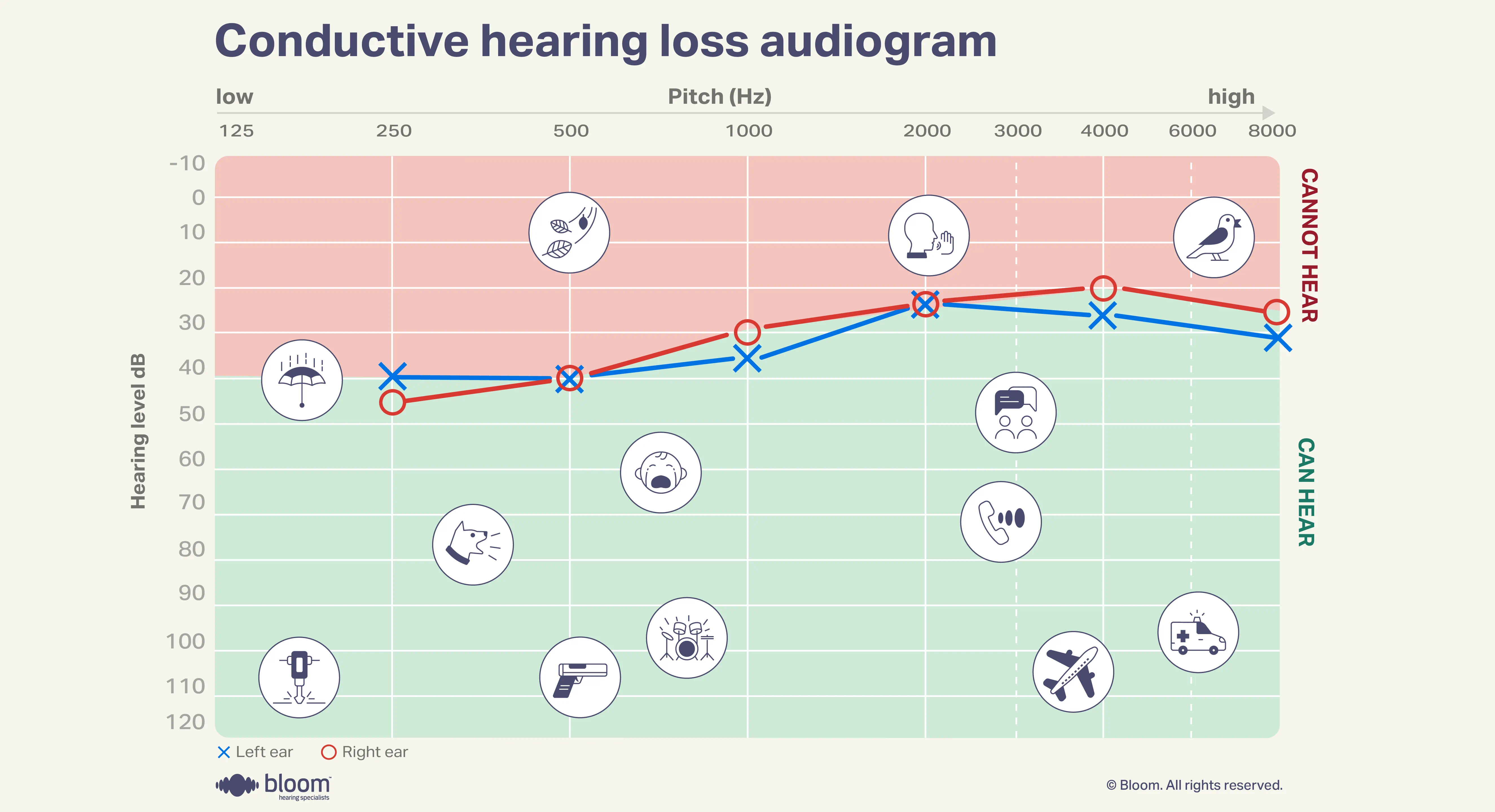 Audiograma representando perda auditiva condutiva, indicando problemas na transmissão do som através do ouvido externo ou médio.