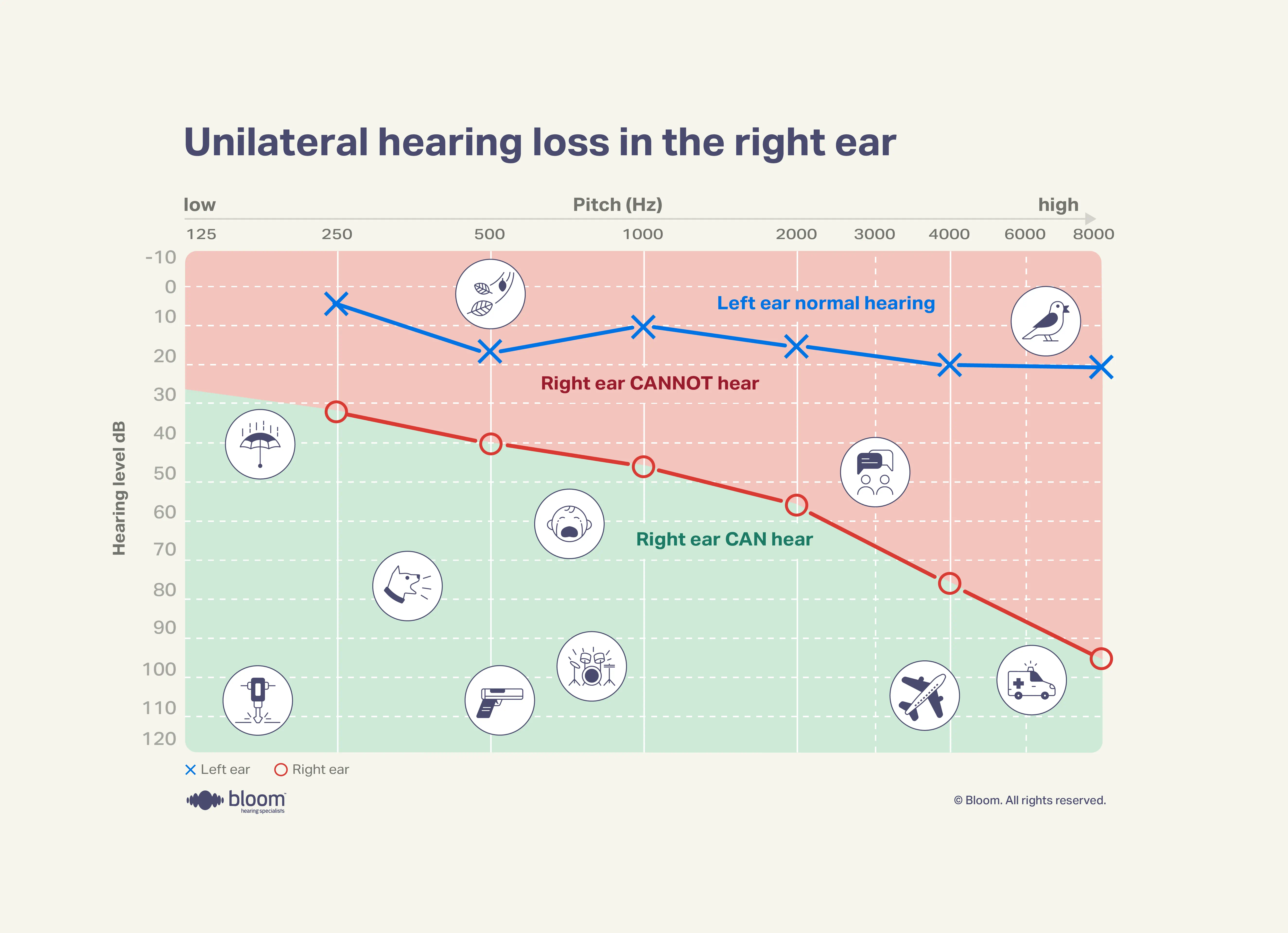 Audiograma mostrando perda auditiva unilateral, afetando apenas o ouvido direito.