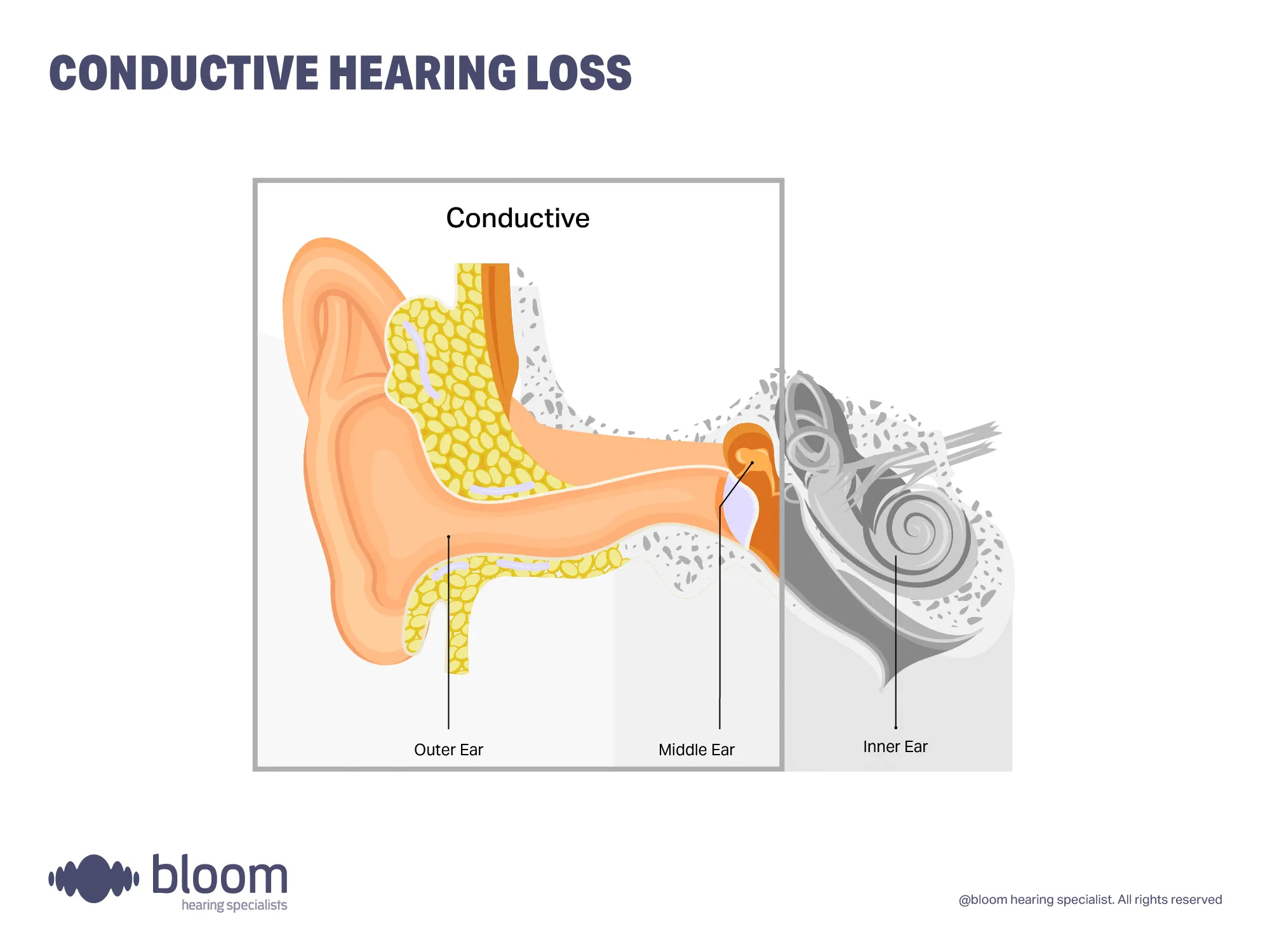 conductive-hearing-loss-4x3