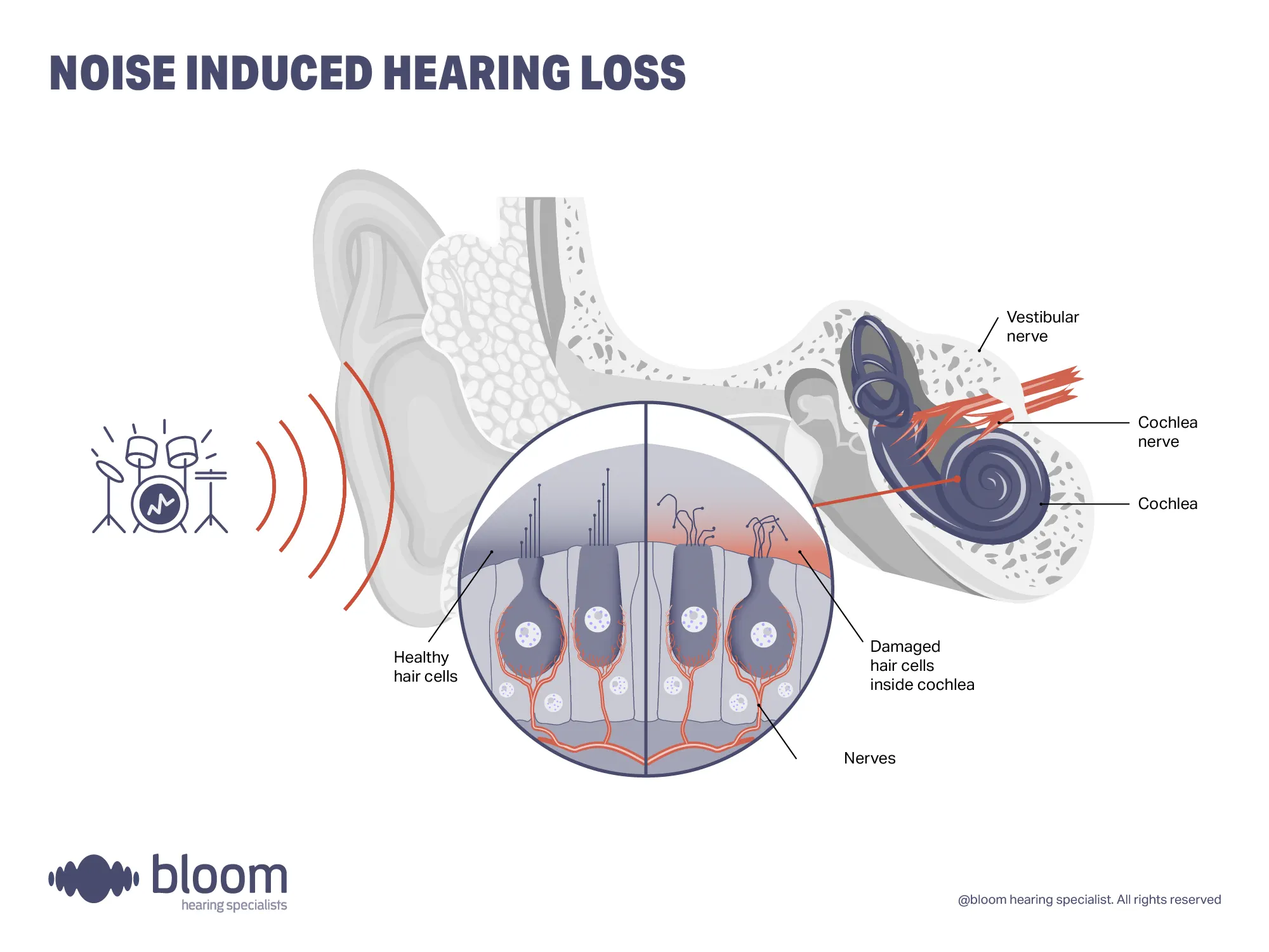 noise-induced-hearing-loss-4x3
