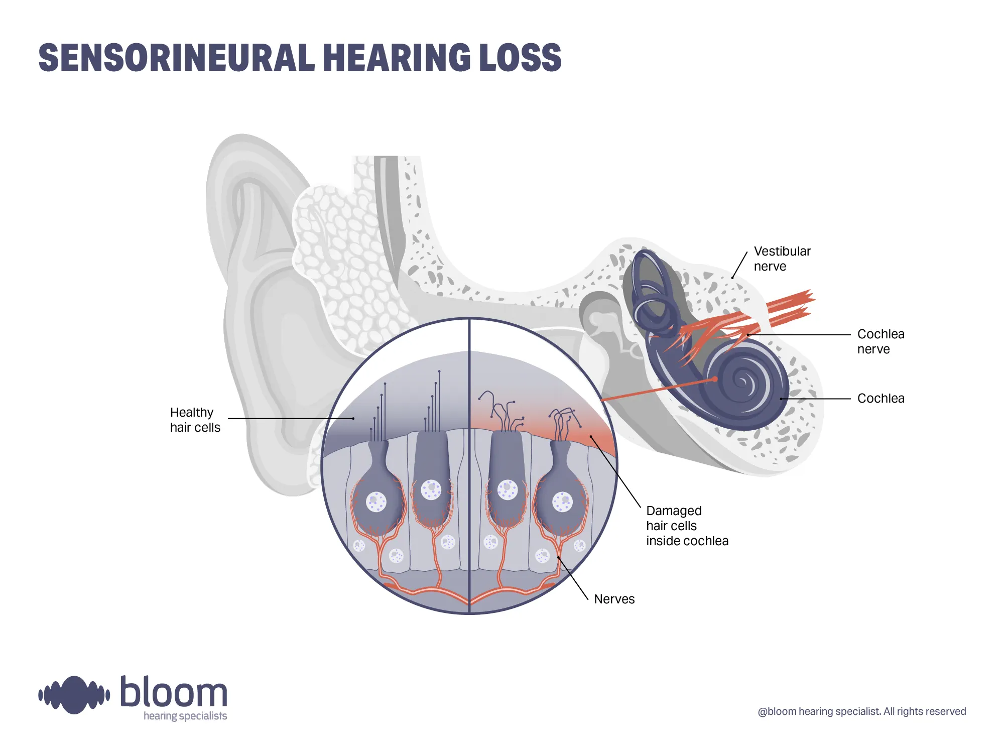 sensorineural-hearing-loss-4x3